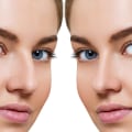 Highly Recommended Rhinoplasty Surgeon in Beverly Hills CA