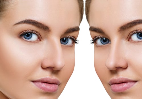 Highly Recommended Rhinoplasty Surgeon in Beverly Hills CA